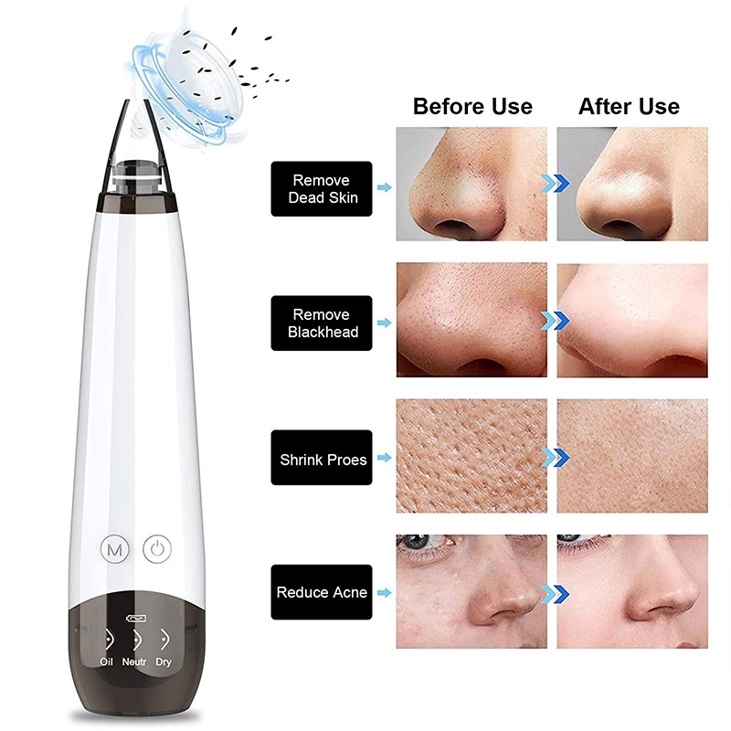 Blackhead Remover Pore Vacuum 2