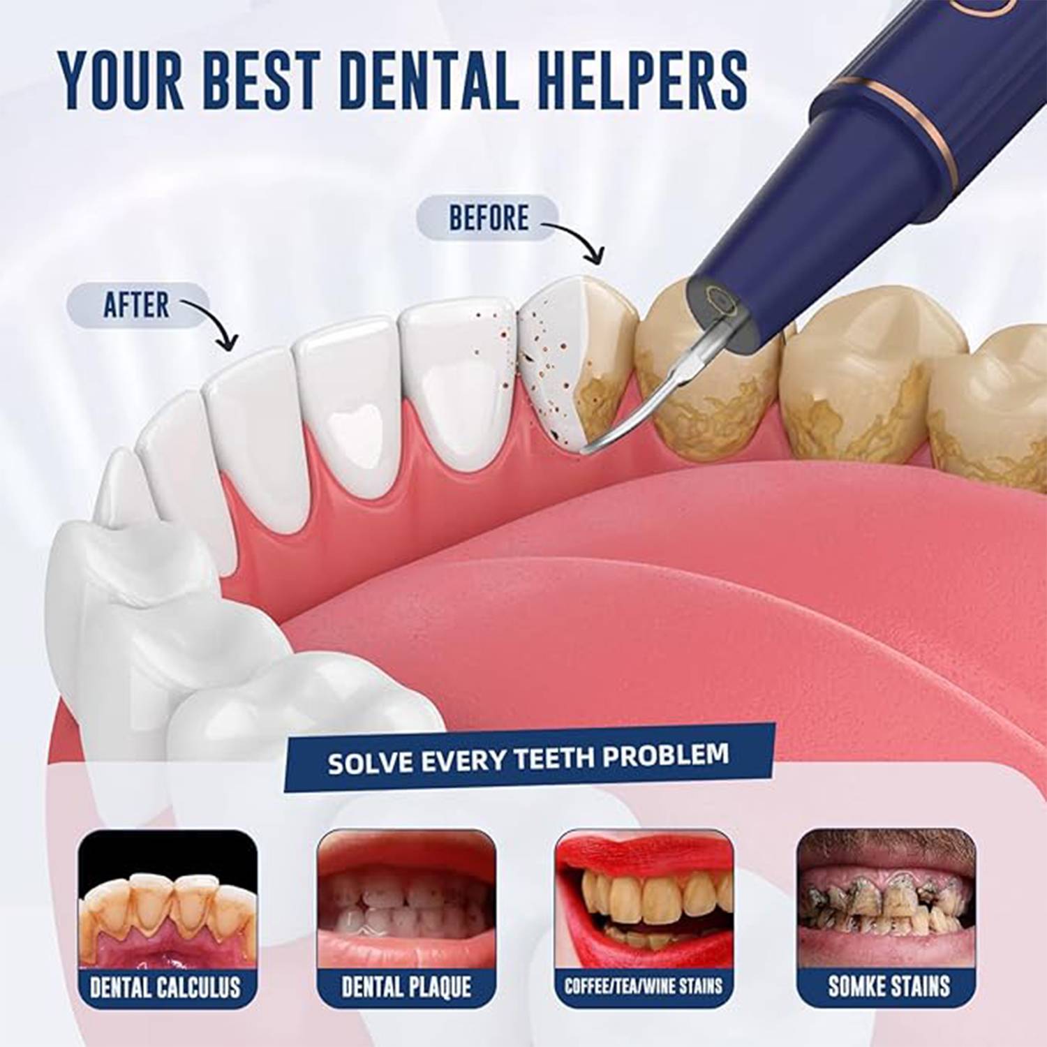 Plaque/Tartar Remover for Teethv 2