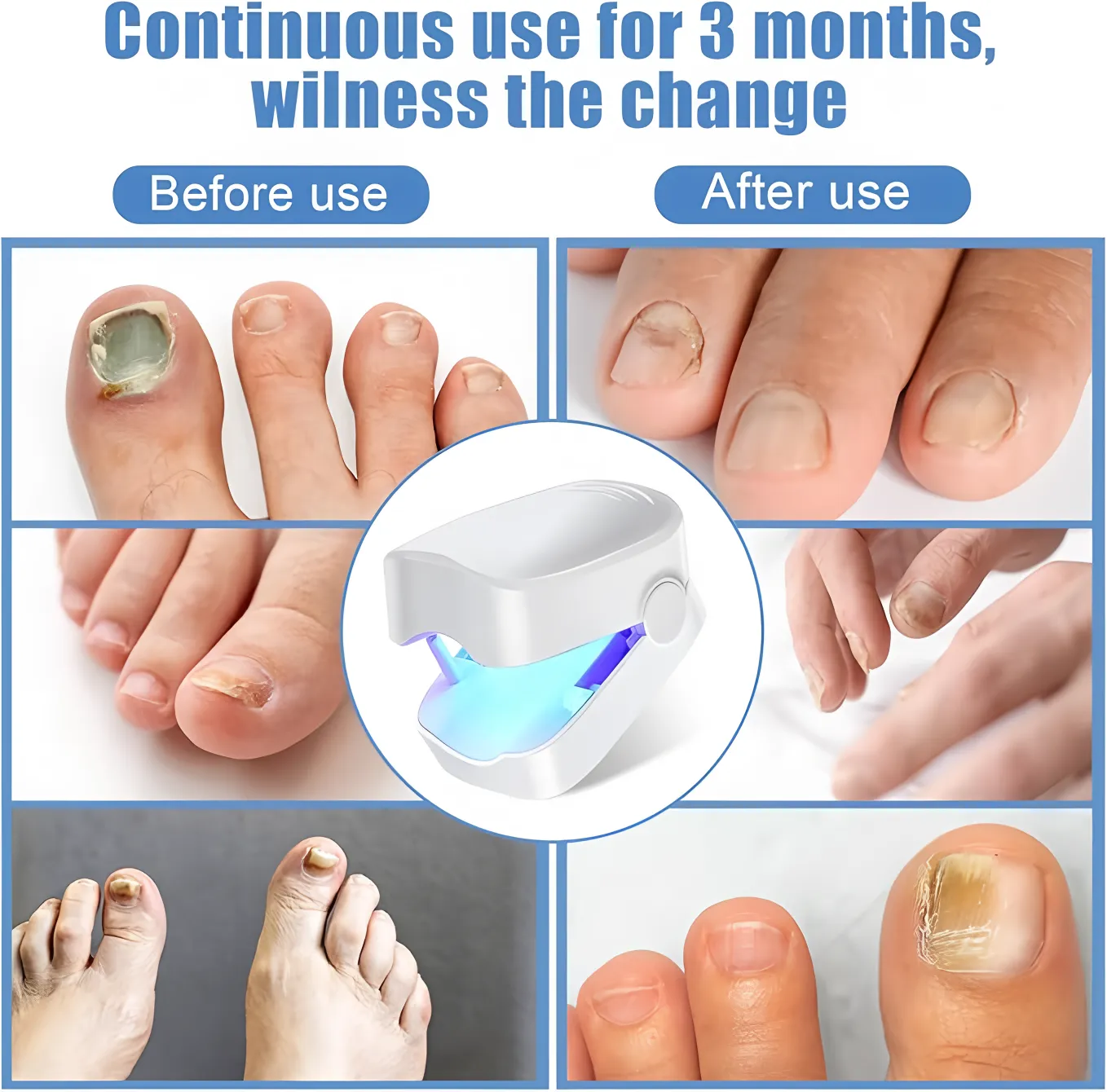 LED Nail Therapy Device for Toenail Care 4