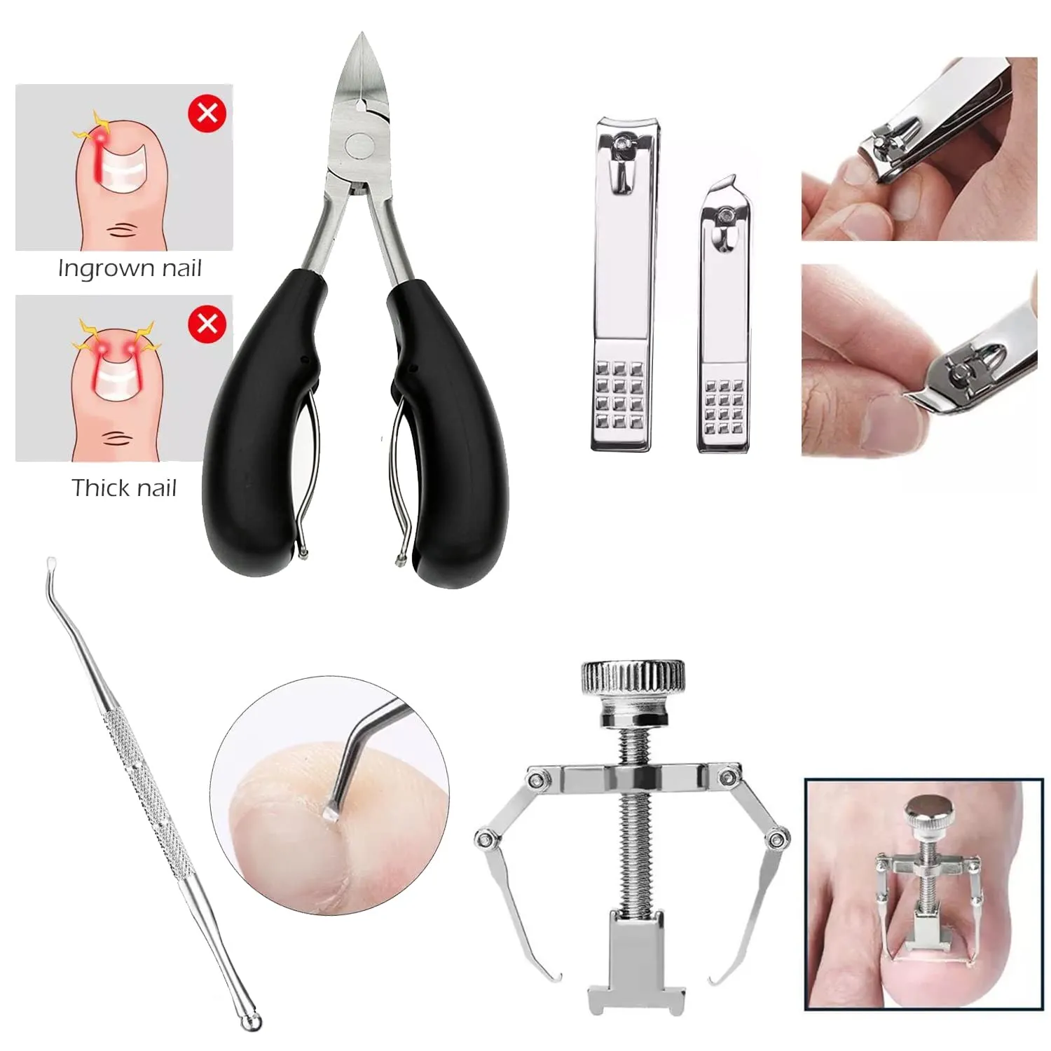 Ingrown Toenail Clipper Kit 1
